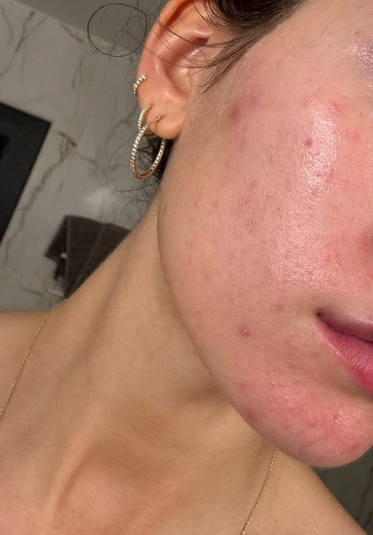 How to Treat Acne Without Damaging Your Skin Barrier (Gentle Routine That Works)